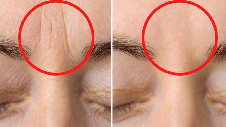 réduire les rides entre les sourcils